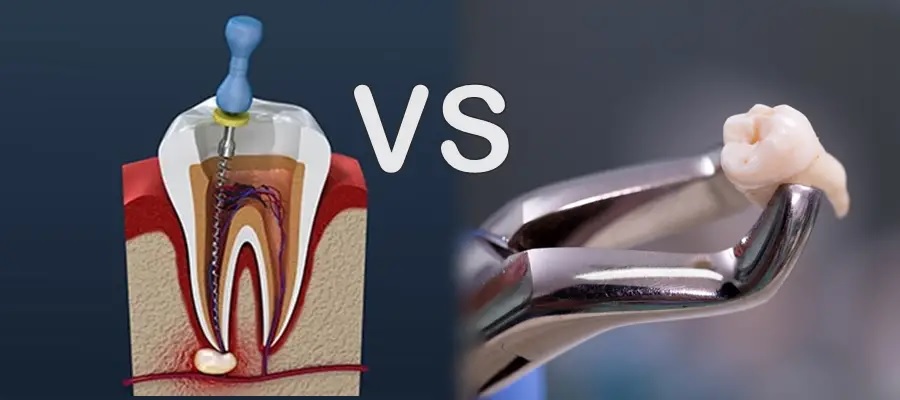 Endodontics-vs-Extraction
